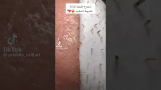 أسرع طريقه للتخلص من الخيوط الدهنيه Suspicious Filaments 