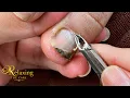 Professional foot callus remover part 15