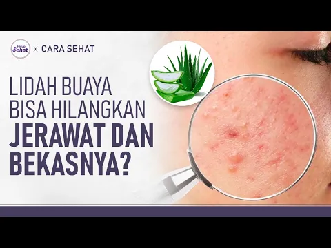 Cara Pakai Lidah Buaya Untuk Jerawat, Bekas Jerawat dan Iritasi Kulit