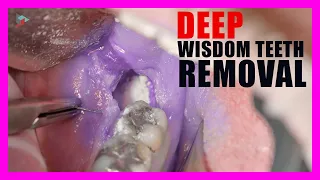 Download Wisdom Teeth Removal | Tooth Sectioning Procedure. Surgical Guide + Online Courses! MP3