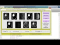 Brain Tumor Detection Using Watershed Technique Matlab Project with Source Code