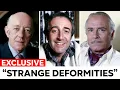 17 Old British Actors With Secret Disabilities and Deformities