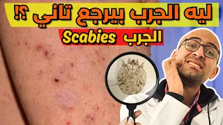 علاج الجرب النهائي  بالتفاصيل    وليه بيرجع تاني   دندنها