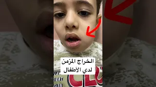 علاج الخراج المزمن لدي الأطفال   أسنان  طبيبة اسنان  خراج مزمن  طبيبة أطفال دندنها