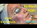 So much pop Acne extractions on severe inflammatory acne Multiple blackheads and whiteheads