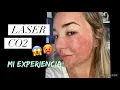 TODO SOBRE EL LASER FRACCIONADO PIEL DE BEBE ALEJA FRANCO