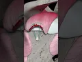 Rotator Cuff Repair Animation