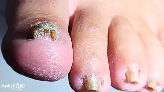 FUNGO NA UNHA AVANÇADO: o começo do tratamento que vai mudar tudo #podologomaurelio #satisfying