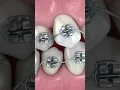 braces procedure how braces work