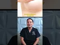 Scared of scarring after breast implants