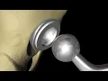 Total Hip Replacement