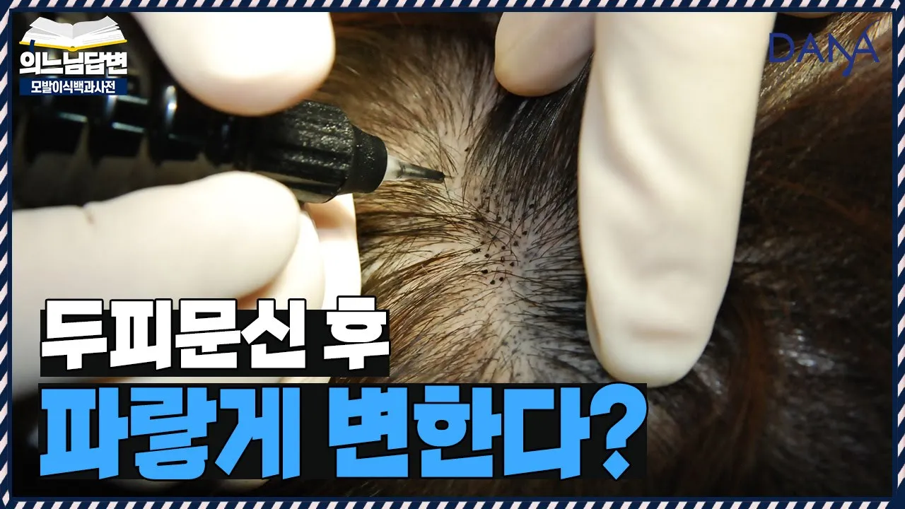 의느님답변📂두피문신 후 파랗게 보이는 이유ㅣ두피문신 4가지 원칙ㅣ다나성형외과(DANA)ㅣ모발이식ㅣ헤어라인교정ㅣ두피문신ㅣ탈모치료