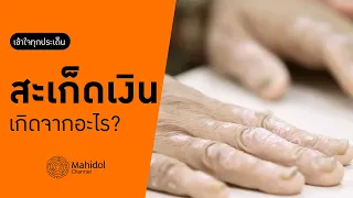 โรคสะเก็ดเงินเกิดจากสาเหตุอะไรบ้าง