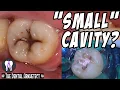 Restoring A Tooth Back To Its Original Shape