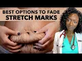 How to Fade Stretch Marks Causes Treatments Best Products to Get Rid Of Stretch Marks