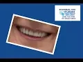 I decided to get Implants and everything turned out wonderful - Affordable Dentures