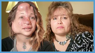 She Nearly Bled To Death Because Of Her Birthmark | Body Bizarre