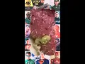 Blackheads Removal Acne Treatment and Very Satisfying Satisfying Pimple pop