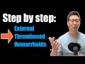 Step by step guide External Thrombosed Hemorrhoids