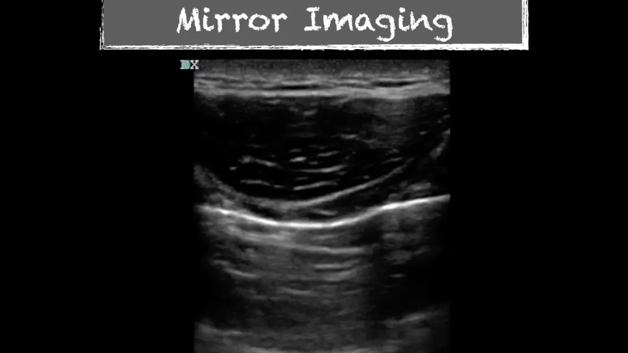 Ultrasound Physics Imaging Artifacts