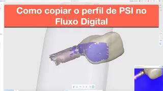 Escaneamento de Perfil de Coroa Provisória sobre Implante