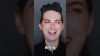Jade Australia FFS Surgery Stories
