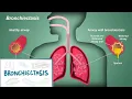 Bronchiectasis