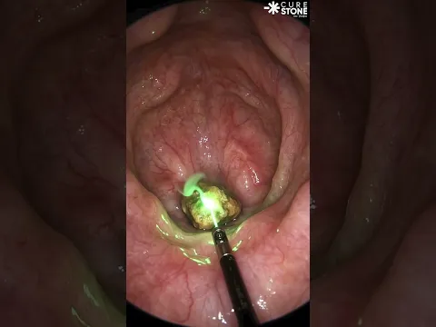 Treatment is of urinary bladder stone using laser #urology