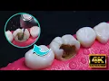 Download Lagu INCREIBLE reconstrucción de diente dañado por caries: Endodoncia en 4K