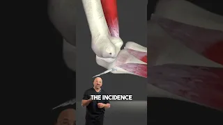 Tommy John Elbow Surgery Faster Pitching