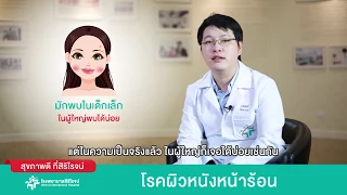 สาเหตุหลักที่ทำให้ฝ้าเห็นชัดขึ้นคืออะไร และควรป้องกันอย่างไร