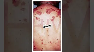 اعراض الايدز الاوليه بالترتيب ٩ علامات تخبرك انك مصاب بفيروس نقص المناعة البشرية HIV 