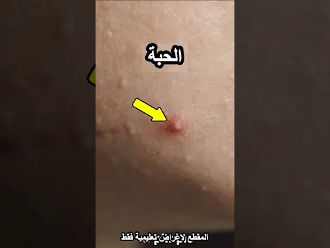 ايش بيصير اذا طلعت لك حب بالوجه 😎😎 #shortvideo
