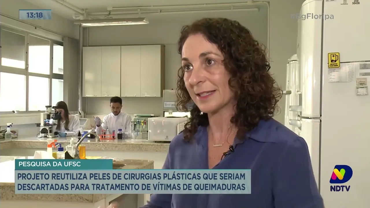 Projeto da UFSC reutiliza peles de cirurgias plásticas para tratamento de vítimas de queimaduras