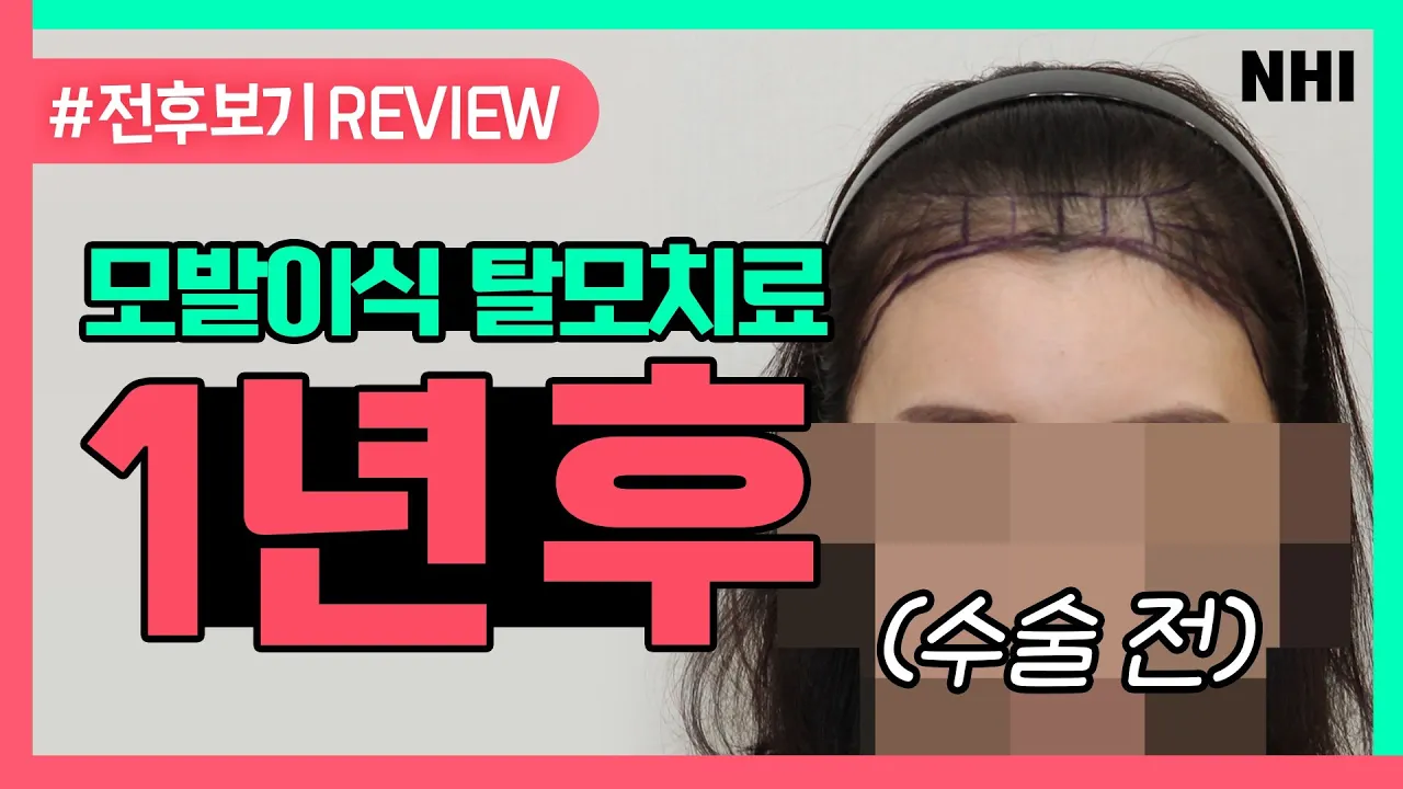 확 달라지는 헤어라인교정 (넓은이마,각진이마 시청 필수)ㅣ전후보기reviewㅣ뉴헤어