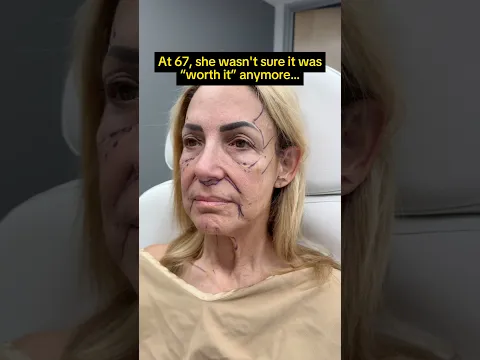 67 Year Old Facelift Transformation 😍 Dr. Truesdale