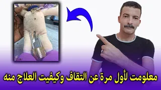 معلومت لأول مرة عن التقاف وكيفيت العلاج منه دندنها