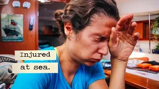 2nd degree burn at sea: how we dealt with it and what we learned from it.  #47