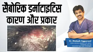  four reasons of flaking in scalp hair problems episode 5