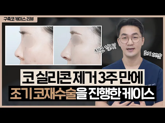 [구축코 케이스 리뷰] 코 실리콘 제거 3주만에 코재수술을?!｜차민을 찾아온 사람들👨‍⚕️