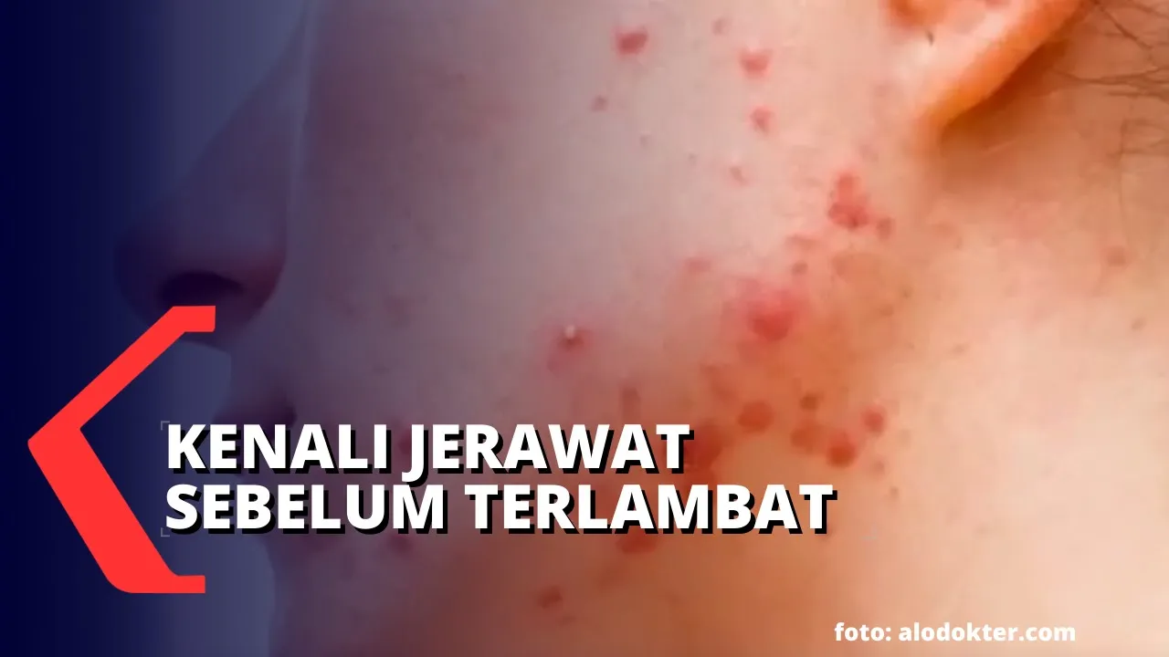 Jerawat di hidung ataupun dagu yang tidak kunjung hilang?