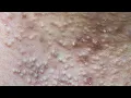 Download Lagu Acne Treatment For \