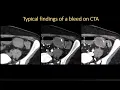 CTA for Acute Bleeding Pearls and Pitfalls by Jody Shen MD