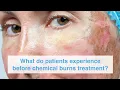 Download Lagu What do patients experience before chemical burns treatment?