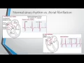 Download Lagu Atrial Fibrillation AF