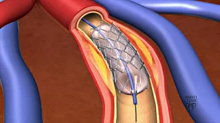 Animation Coronary Stent Placement 