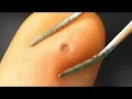 Download Lagu THE MOST BEAUTIFUL PIMPLE UNDER A MICROSCOPE!