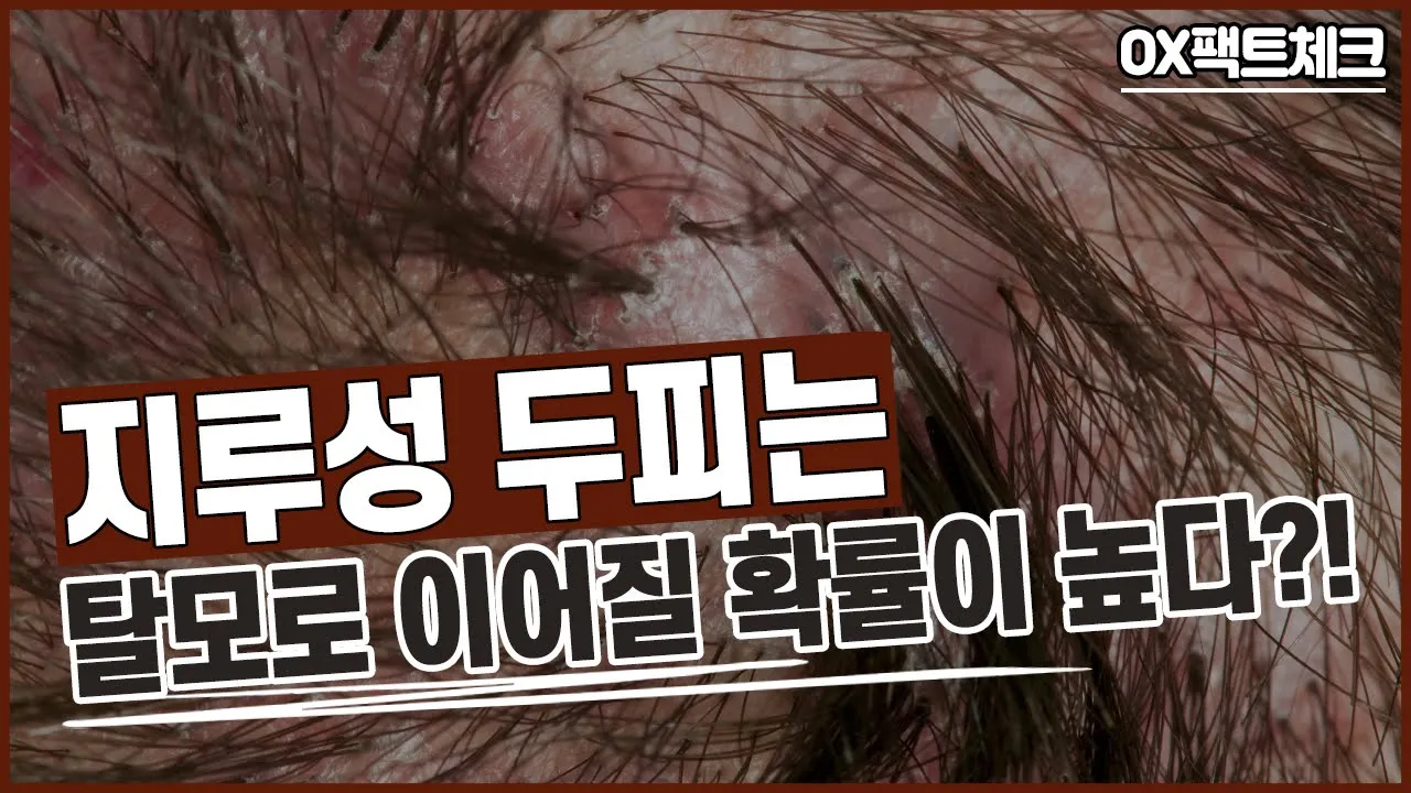 👂지루성 두피는 탈모로 이어진다? [OX 팩트체크_12회]