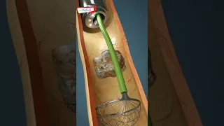 إستخراج حصى الحالب معلومة رائعة 