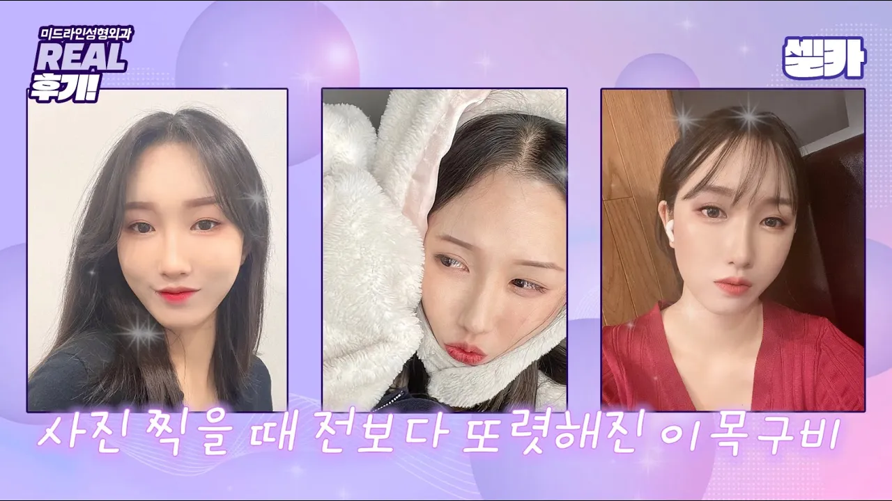 성형외과 직원도 받은 이 수술? 내시경이마거상, 하안검, 눈밑지방재배치, 뒷트임 리얼 후기 [미드라인성형외과 midline plastic surgery]